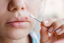 Die dauer des lippenherpes hängt in erster linie von der behandlung und der ursache ab. Herpesblaschen Das Sollten Sie Wissen Und Jetzt Tun Gala De