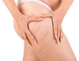 как убрать апельсиновую корку на лице в домашних условиях Kak Izbavitsya Ot Cellyulita 4 Stadii I Vse Metodiki Borby 2 0 2 0