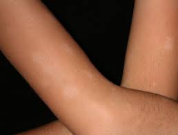 Maybe you would like to learn more about one of these? Pityriasis Alba Dermnet Nz