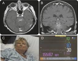 †department of radiology stony brook university in addition, we also present a unique case of newly described autoimmune entity clippers syndrome. Central Neurogenic Hyperventilation Neurology