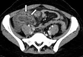 Image result for Neutropenic Colitis