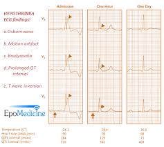 You are in the right place and time to meet your ambition. Ecg Changes In Hypothermia Epomedicine
