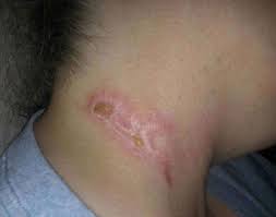 These result from things such as hot metals, steam, flames, or scalding liquids getting into contact with your. 2nd Degree Burns Photos Causes Treatment