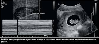 See full list on radiopaedia.org When A Pregnancy Fails Early