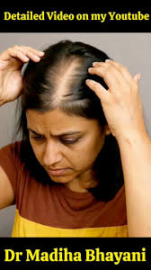 How to Grow your Hair Line Back