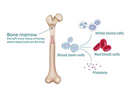 This is most common type of bone marrow cancer. Bone Marrow Aspiration And Biopsy In Childhood Cancer Together