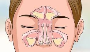 Nasul infundat, unul dintre cele mai comune simptome ale racelii si gripei, dar si al alergiilor, provoaca disconfort. Cum SÄƒ È›i Desfunzi Nasul In Cateva Minute Doza De SÄƒnÄƒtate