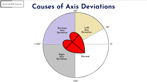 Image result for Left Axis Deviation