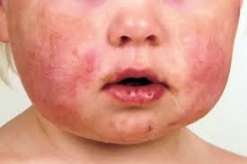 Image result for Papular Acrodermatitis