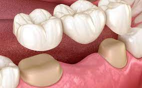 Tipos De Ortodoncia Teeth Treatment Dental Bridge Dental Implants Cost
