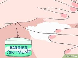 Intertrigo is more common in warm, moist climates. Intertrigo Behandeln Wikihow