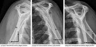 Acromion, bigliani found three , type edited by. Acromial Types As Proposed By Bigliani Et Al 1986 A Type I Flat Download Scientific Diagram
