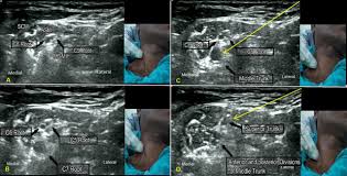 Image result for Superior Trunk Block