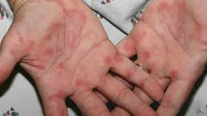 A raised, itchy red rash (hives) can appear as an allergic reaction to things like stings, medicines or food. Palm Rash 8 Common Causes And Treatment Options