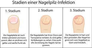 Fungustan Ad Nagelpilz Richtig Behandeln So Kann Es Funktionieren Produkt Check Online Cilt Bakimi