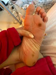Image result for brown patches on the feet