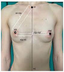 IJERPH | Free Full-Text | Breast Fluctuating Asymmetry in Women with  Macromastia/Gigantomastia
