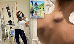 Brave young woman who waged high-profile melanoma campaign loses cancer  battle aged 28 | Daily Mail Online