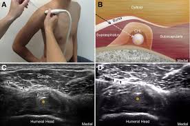 Image result for Subacromial Space Injection