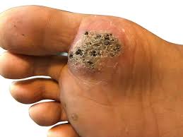 These foot warts can look like thick, hard patches of skin that have specks and they will grow back into the they do most often show up on hands and feet but otherwise are not a specific wart type by. Seed Wart Causes Symptoms Treatment Methods For Removal