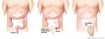 Abdominoperineal Resection Wikipedia