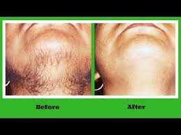 How To Get Rid Of Facial Hair Naturally Permanently At Home Remove Facial Hair Naturally At Home Hair Removal Permanent At Home Hair Removal Chin Hair Removal