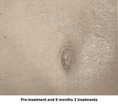 This includes stretch mark creams, oils, and lotions. The Genius Way To Get Rid Of Stretch Marks Aesthetic Assets Aesthetic Medical Spa