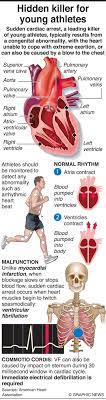 Sudden cardiac arrest usually results from an electrical disturbance in your heart that disrupts its pumping action (ventricular arrhythmia), stopping blood flow to the rest of your body. Infographic Sudden Cardiac Arrest Is A Hidden Killer For Young Athletes Football Gulf News