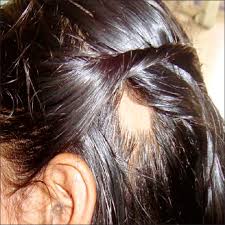 In many cases, patients will experience spontaneous hair regrowth without any treatment within a year. Alopecia Areata Of Dental Origin In A Child Samuel A V Muthu M S Gurunathan D Sharma A Indian J Dent Res