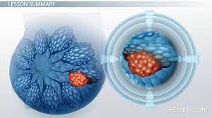 Cancerous tumors spread into, or invade, nearby tissues and can travel to distant places in the body to form new tumors (a process called . What Is A Malignant Tumor Definition Treatment Video Lesson Transcript Study Com