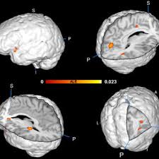Check spelling or type a new query. Pdf A Meta Analysis Of Neuroimaging Studies On Divergent Thinking Using Activation Likelihood Estimation Divergent Thinking