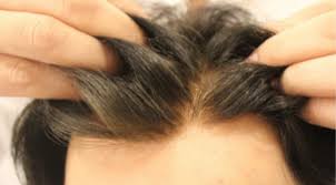 En Iyi Protez Sac Sistemi Hangisidir Hairhotel