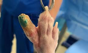 Image result for toe amputation