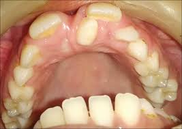 Check spelling or type a new query. Double Mesiodens In Mixed Dentition Period Report Of 3 Cases Rana Ss Ohri N Srm J Res Dent Sci