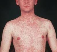 Image result for measles
