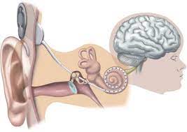 Do ultrasonic pest repellers work ? Schematic Illustration Of The Position Of A Cochlear Implant Download Scientific Diagram