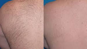 Laser Hair Removal – Beauty Clinic Dr. Tameh