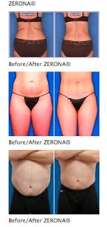 Pin On Before After Photos