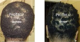 It usually occurs gradually and in predictable patterns — a receding hairline and bald spots in men and thinning hair along the crown of the scalp in women. Why Is My Afro Hair Thinning At The Crown Protress Hair Care