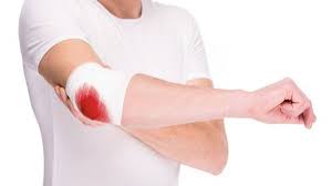 A collection of disease information resources and questions answered by our genetic and rare diseases information specialists for hemophilia a. Dia Mundial De La Hemofilia Una Enfermedad Ligada Al Cromosoma X As Com