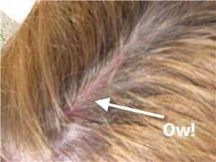 A sunburned scalp is not a common condition and the vast majority doesn't know that it can happen. Beware Of Sunburned Hair