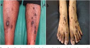 Picture of lichen planus 1. Figure 2 From Hypertrophic Lichen Planus Versus Prurigo Nodularis A Dermoscopic Perspective Semantic Scholar