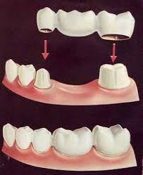 Apabila anda mempertimbangkan untuk menanam gigi palsu (dental implants), anda juga perlu mengetahui keuntungan lainnya bahwa implants lebih mudah perawatannya. Bridge Kebaikan Dan Keburukan Saranan Doktor Gigi Dan Testimonial Pesakit