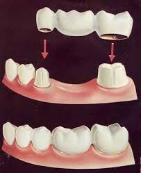 Bridge (model jembatan), menghubungkan gigi dengan gigi tetangga untuk menggantikan satu atau lebih gigi yang telah lepas. Bridge Kebaikan Dan Keburukan Saranan Doktor Gigi Dan Testimonial Pesakit