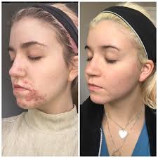 An excess of androgens (male hormones that both men and women have) can cause. B A Jaw Surgery A 2 Year Battle With Hormonal Acne Skincareaddiction