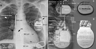 Pacemakers and implantable defibrillators are devices that monitor and help control abnormal heart rhythms. Which Pacemaker Icd Is That Again