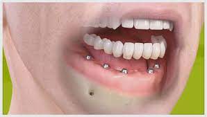 Protese Fixa Para Arcada Completa Com Implantes Straumann Como Funciona Blog Implart