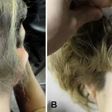 The immune system should normally be fighting infections. Pdf Successful Treatment Of Corticosteroid Resistant Ophiasis Type Alopecia Areata Aa With Platelet Rich Plasma Prp