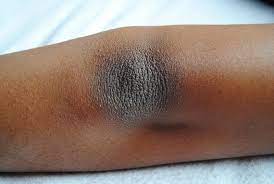10 maneras de como blanquear codos y rodillas oscuras rapido cilt beyazlatma skin care evde hazirlabilen ilaclar