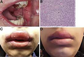 The Proof For Oral Crohn S Disease Is In The Cinnamon Free Pudding Clinical Gastroenterology And Hepatology